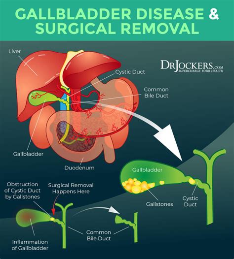 Overcoming the Pain: A Journey Through Gallstone Removal Without a Gallbladder